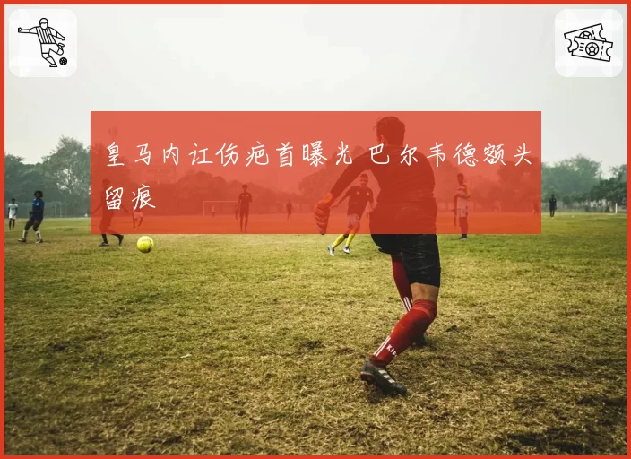皇马内讧伤疤首曝光 巴尔韦德额头留痕